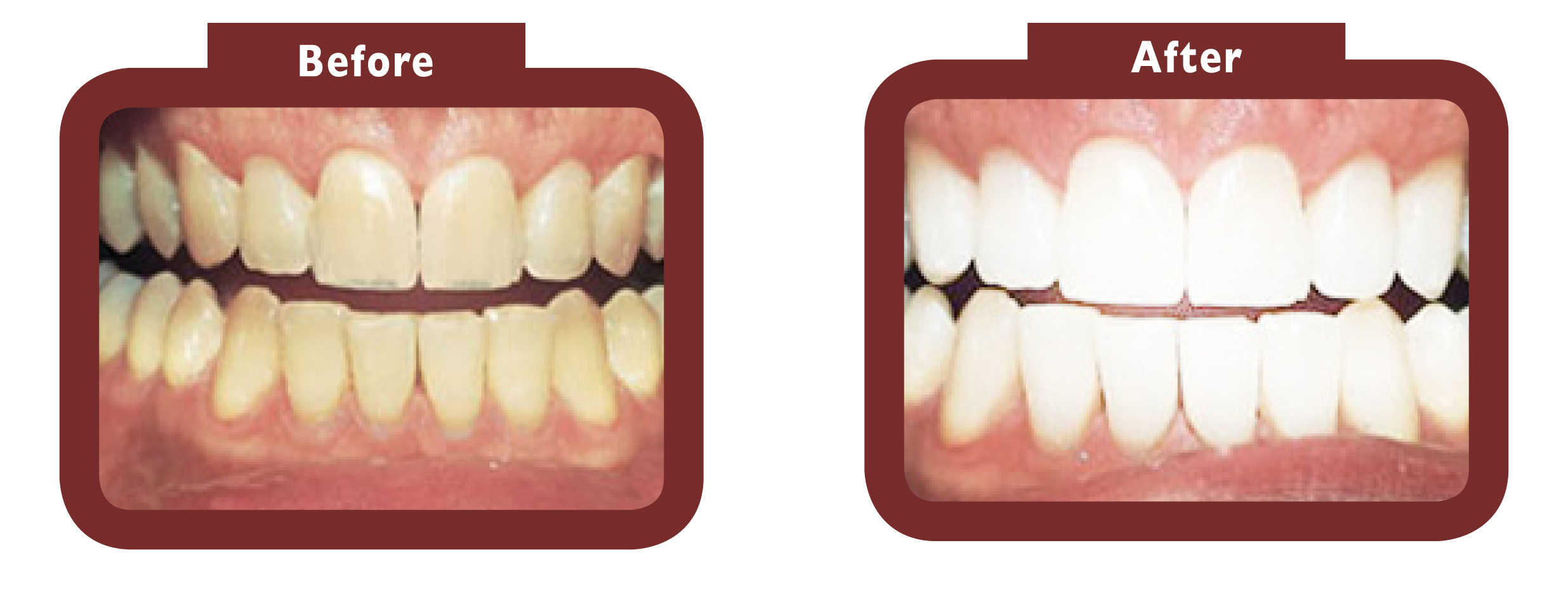 See LA Teeth Whitening before and after results. Contact our team today! Leighton Buzzard