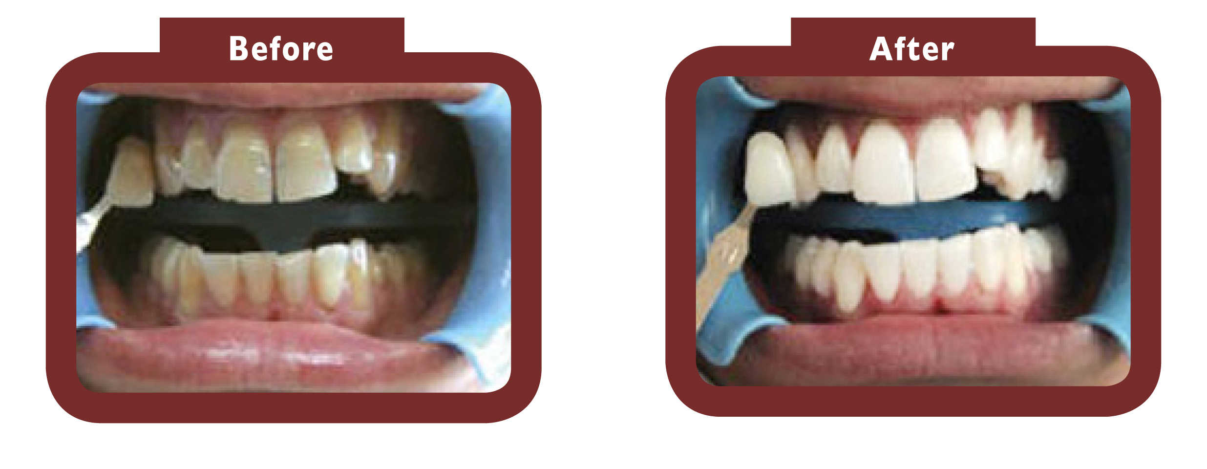 Before and after teeth whitening Leighton Buzzard - LA TEETH Leighton Buzzard