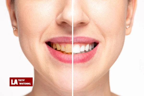 About Us At LA Teeth Whitening Leighton Buzzard Contact us today! Leighton Buzzard