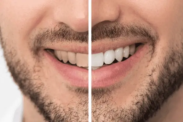 Do you want whiter teeth in just 1 hour? Book your zoom teeth whitening today Leighton Buzzard