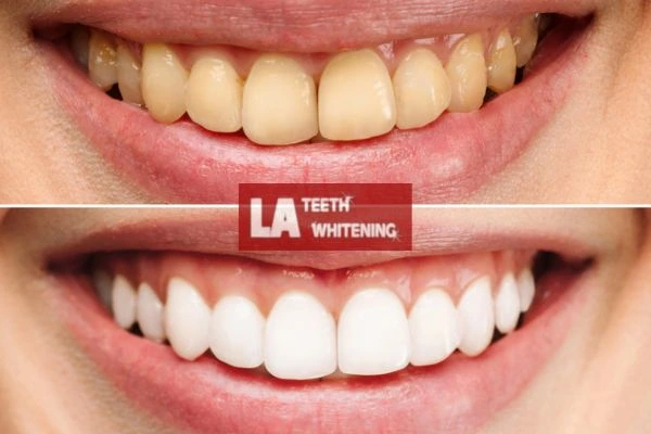 Before and after results - smokers stained teeth results! Leighton Buzzard