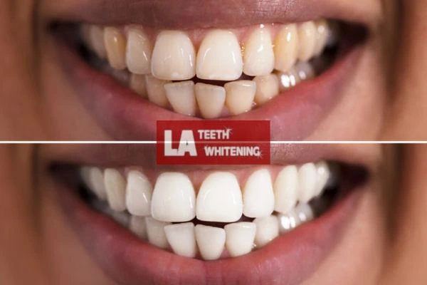 Fast and effective whitening results in one hour. Contact LA Teeth Whitening Leighton Buzzard to book online Leighton Buzzard