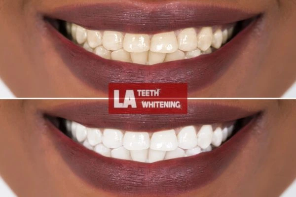 Brighter and white smile - before and after results Leighton Buzzard book online today! Leighton Buzzard