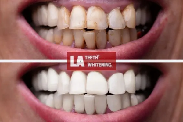 Customer results from LA Teeth Whitening Leighton Buzzard Book today. Leighton Buzzard
