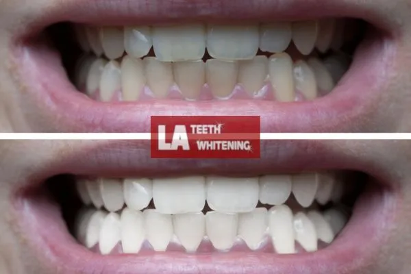 Mens before and after of teeth whitening results Leighton Buzzard Leighton Buzzard