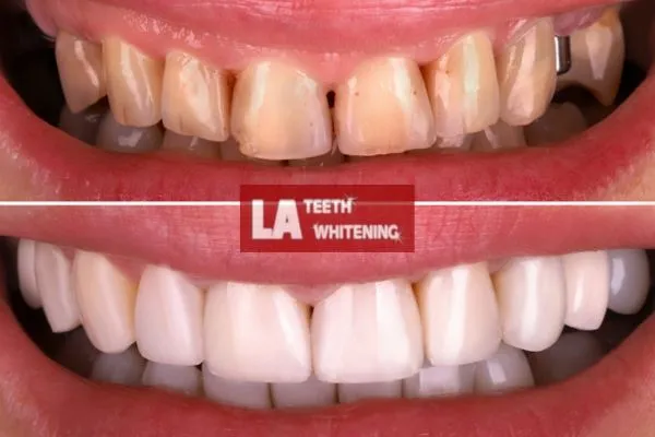 yellow teeth from coffee drinking before and after laser teeth whitening results Leighton Buzzard