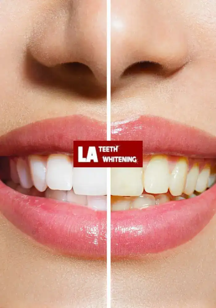 Why Don&rsquo;t Porcelain and Resin Whiten the Same Way as Enamel Leighton Buzzard