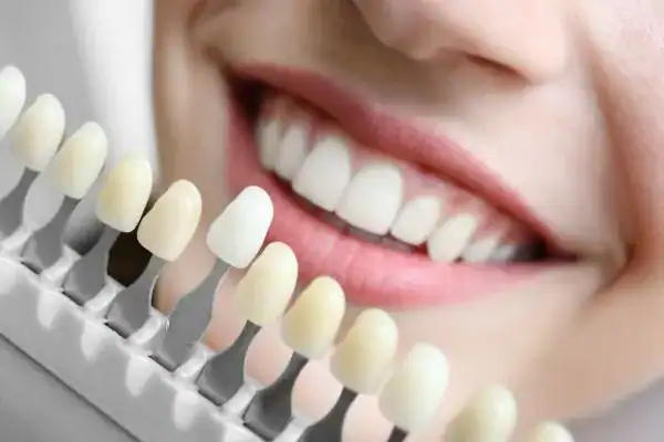 laser whitening Faqs Leighton Buzzard